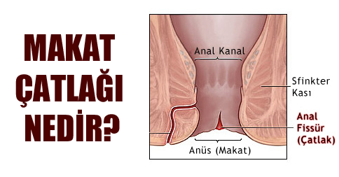 Anal Fissur