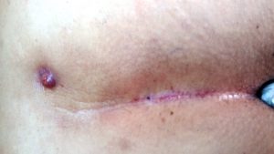 ameliyatsiz-kil-donmesi