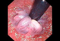 Hemorroides y gases intestinales