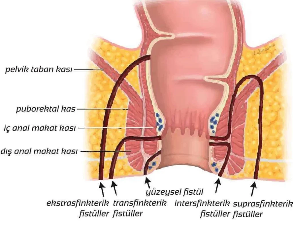 Perianal fistül